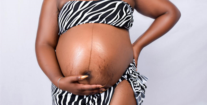 علامات تمدد الجلد أثناء الحمل