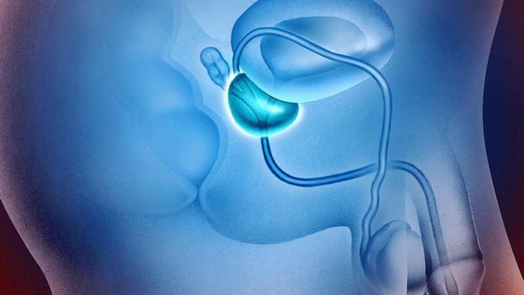 أعراض تضخم البروستاتا الخبيث