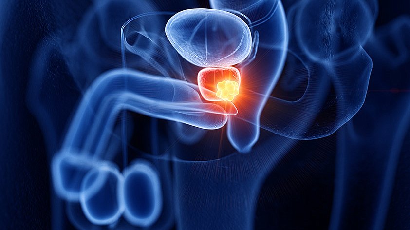 أعراض التهاب البروستاتا وتضخم البروستاتا الحميد