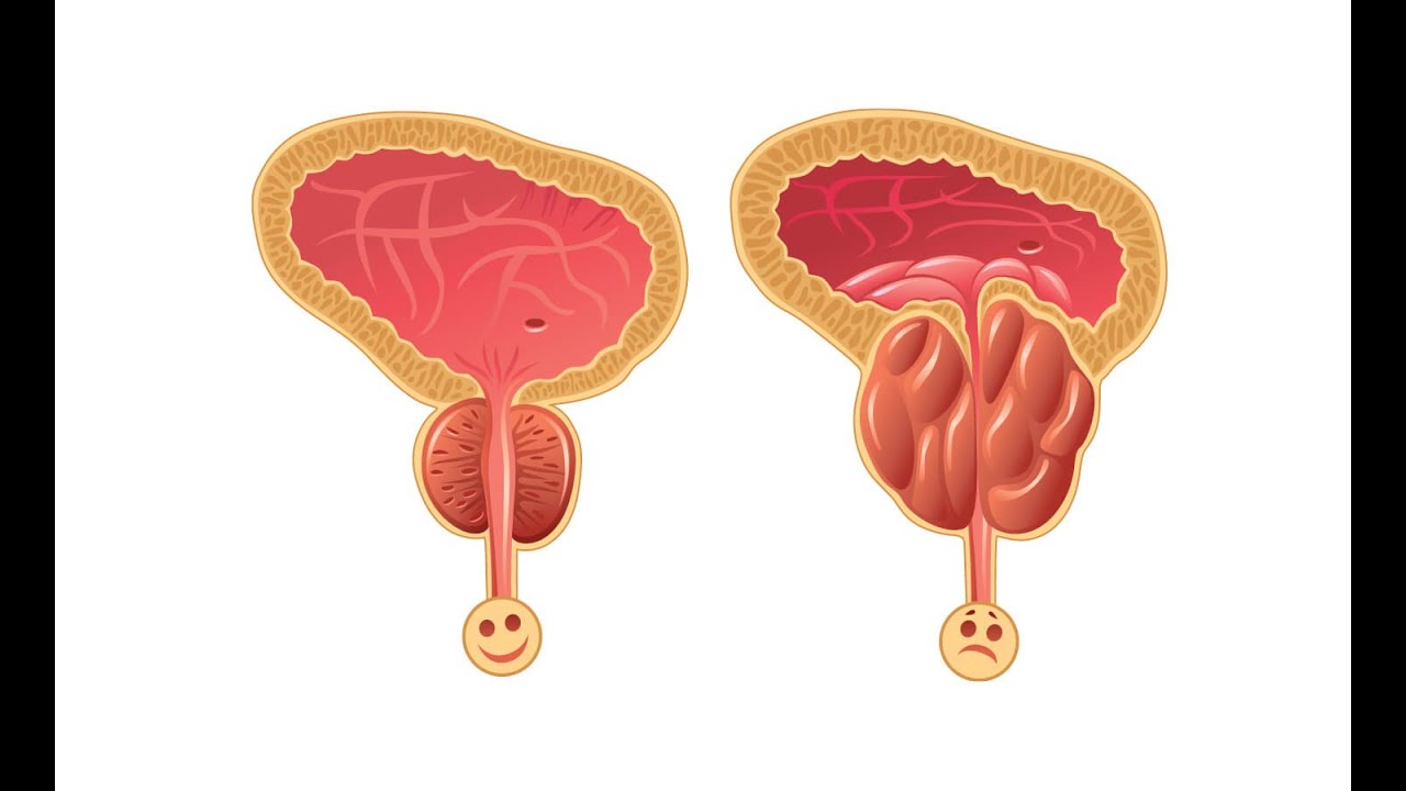 علاج تضخم البروستاتا الحميد طبيعيا