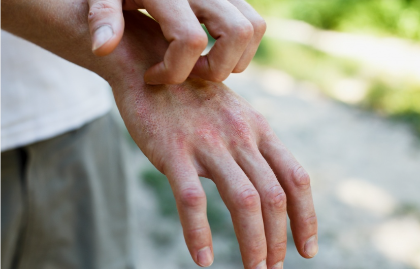 علاج الأكزيما الفطرية والأمراض الجلدية